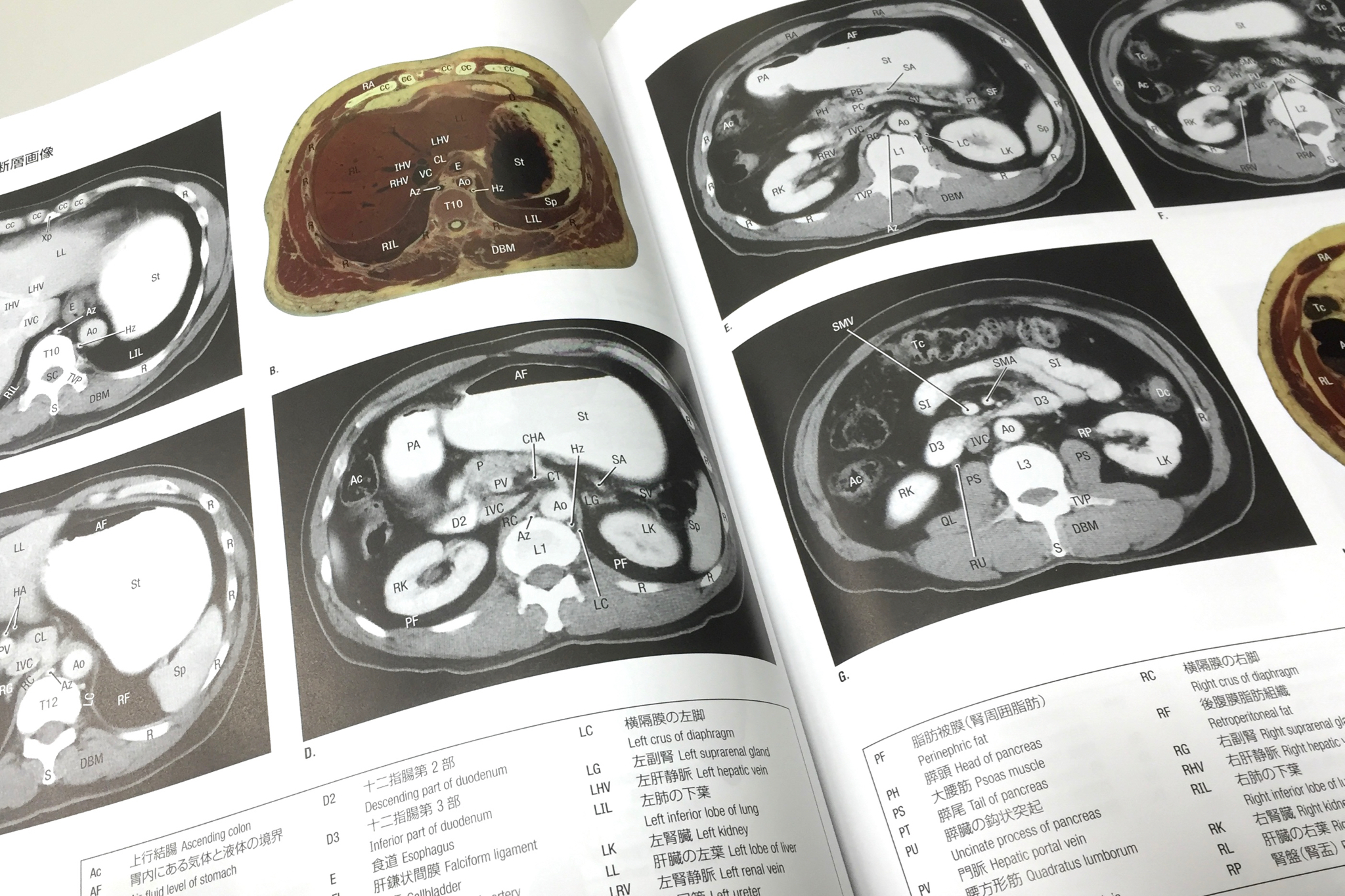 腹部CT
