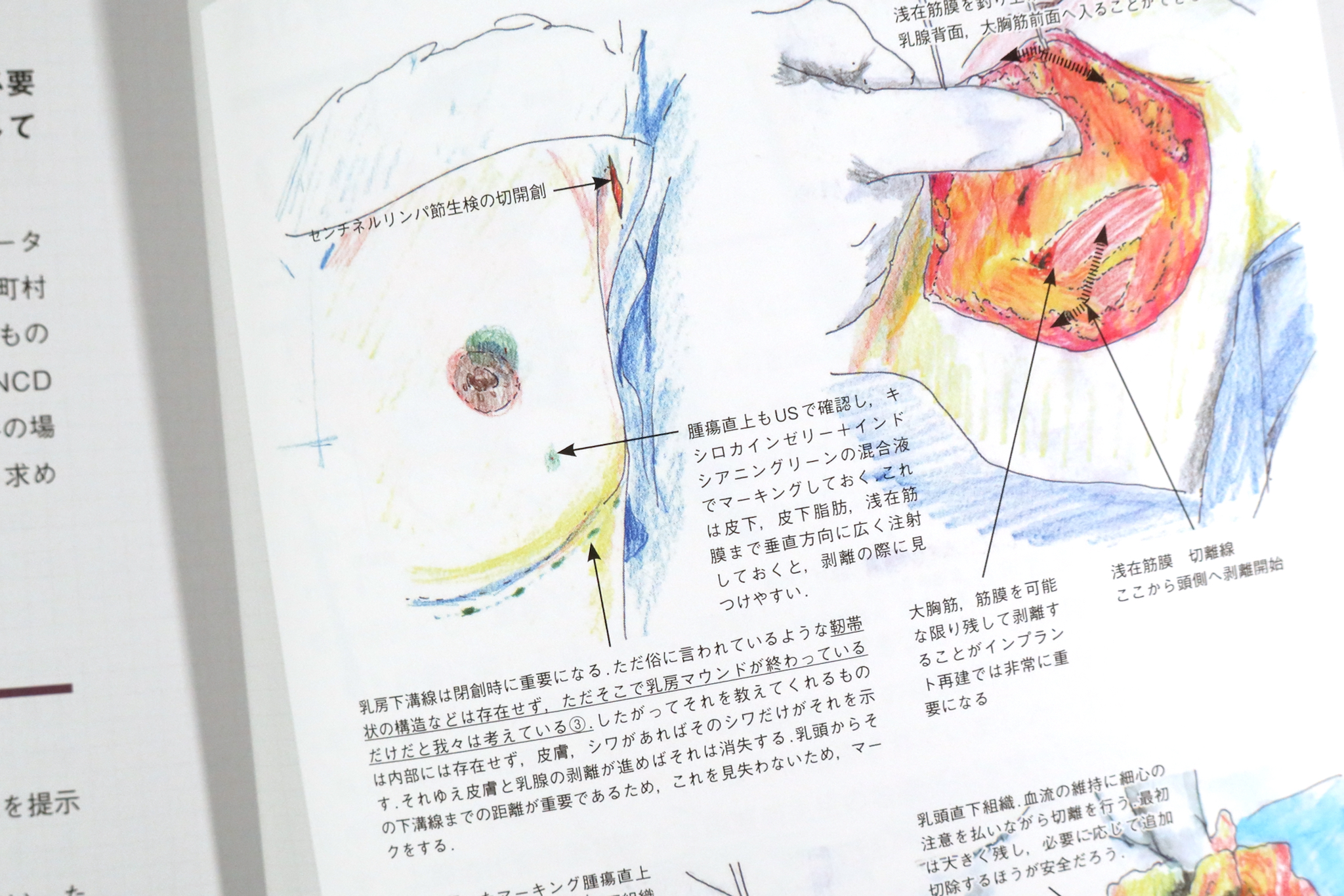 手術記録の描き方 活かし方 デジタルイラストで描くオペレコ入門 Anatomy