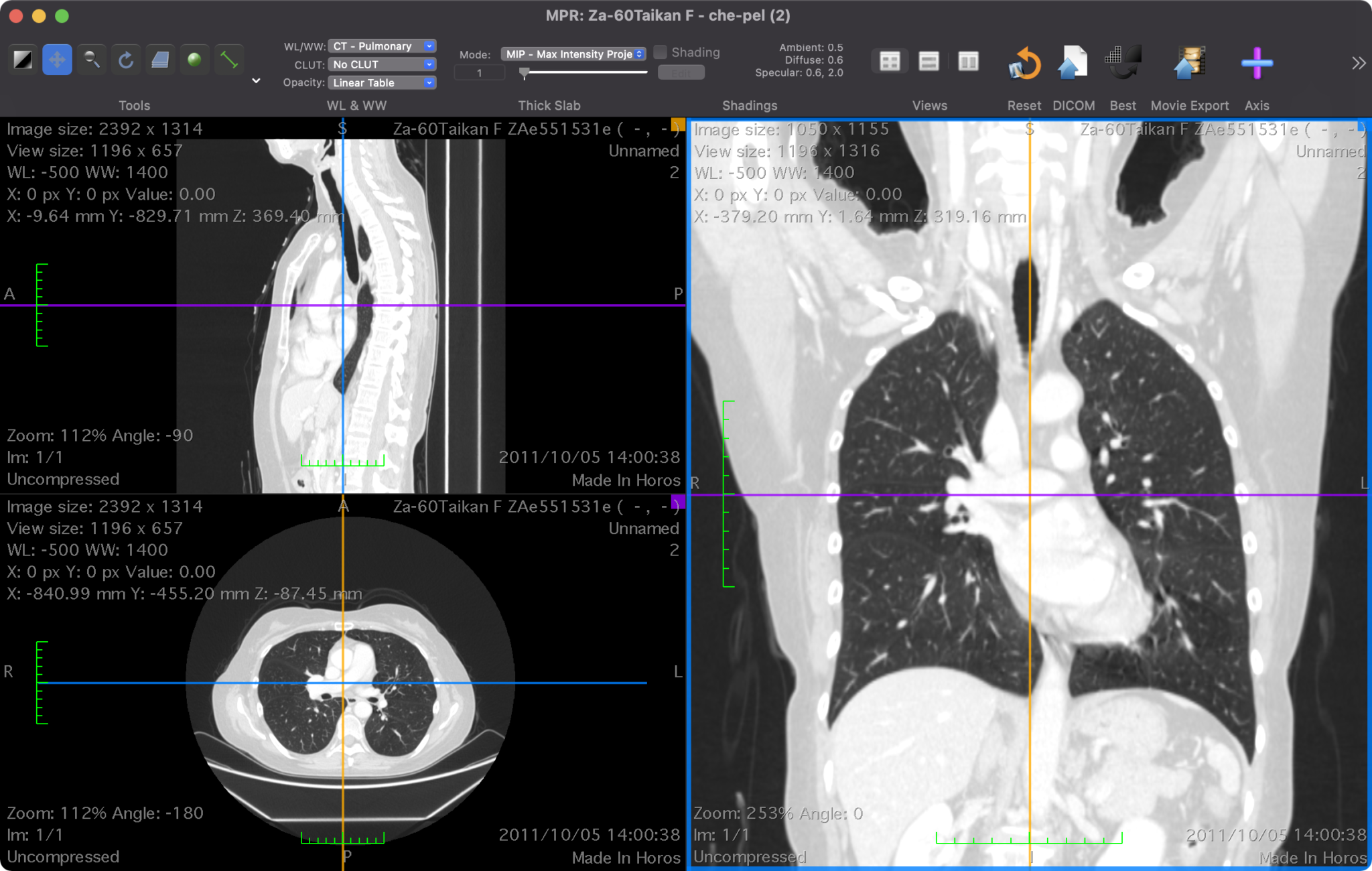 胸部CTの課題について–2022