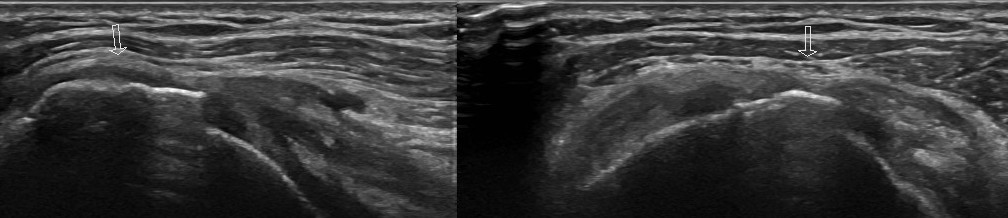 回旋筋腱板の解説をAIに頼む